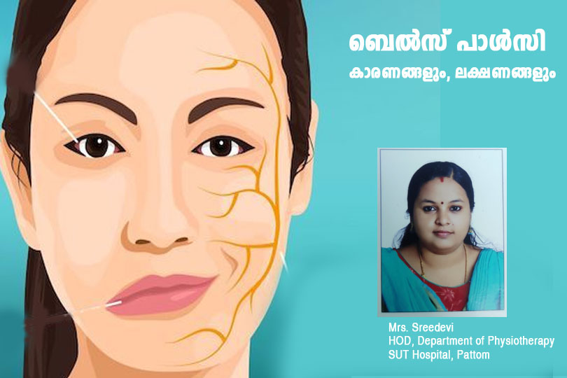 ബെല്‍സ് പാള്‍സി : കാരണങ്ങളും, ലക്ഷണങ്ങളും